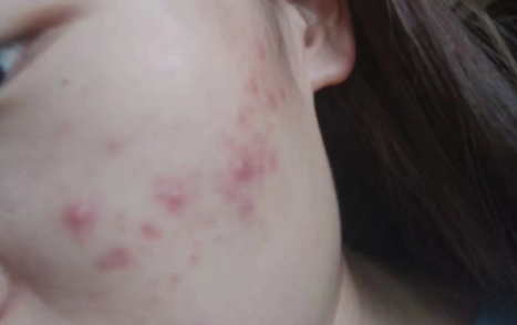 痘痘|痘痘已经平了一直红着可以化妆吗