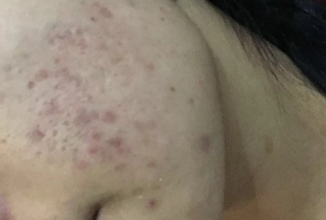 痤疮|痤疮冒出白尖是好事还是坏事