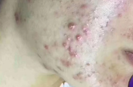 痤疮|痤疮冒出白尖是好事还是坏事