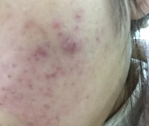痤疮|痤疮千万别去皮肤科什么意思