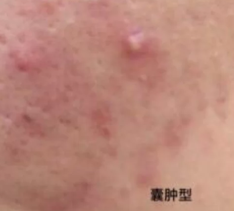 中药|喝中药痤疮一个月了痤疮还是在长