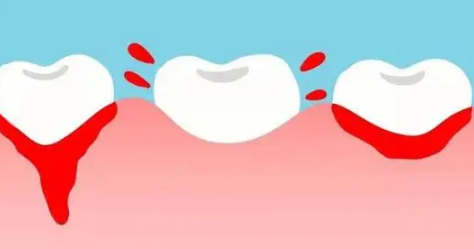 后槽牙|后槽牙崩了一小块要补吗