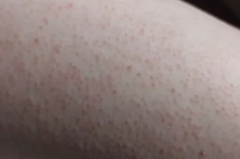 鸡皮肤|鸡皮肤怎么消除