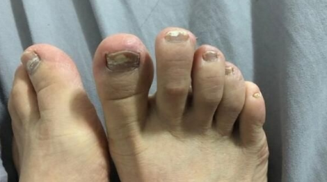 灰指甲|女生得了灰指甲是不是很尴尬