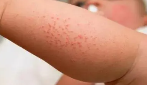 痱子|宝宝痱子怎么快速消除止痒