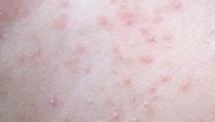 痱子|宝宝痱子怎么快速消除止痒