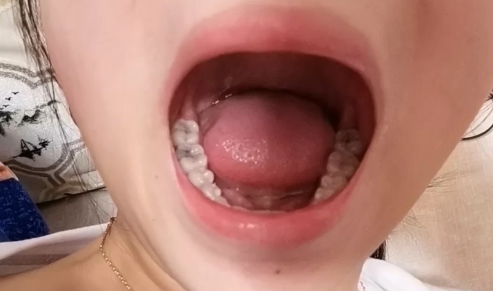 拍片|拍片有智齿一定会长吗