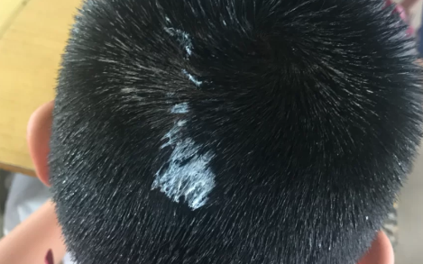 头发|头发上有口香糖用冰块洗可以吗