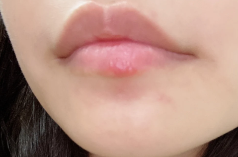 嘴唇|嘴唇疱疹会传染给别人吗