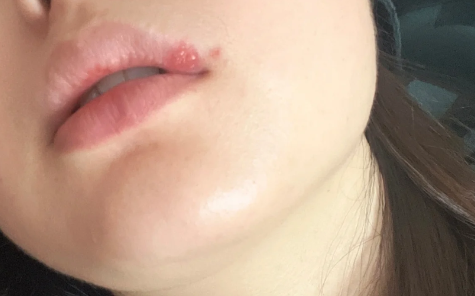 疱疹|带状疱疹结痂后里面有脓咋办