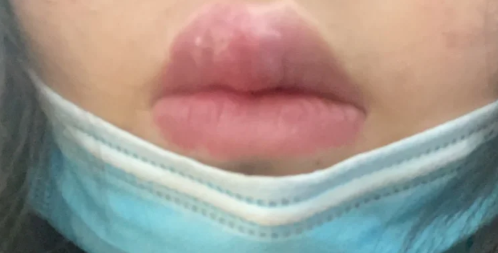 疱疹|疱疹和hpv有关系吗
