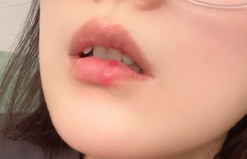 疱疹|疱疹和hpv有关系吗
