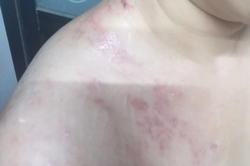生殖疱疹|生殖疱疹终于有特效药了吗