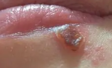 嘴唇|嘴唇疱疹结痂了还要擦药吗