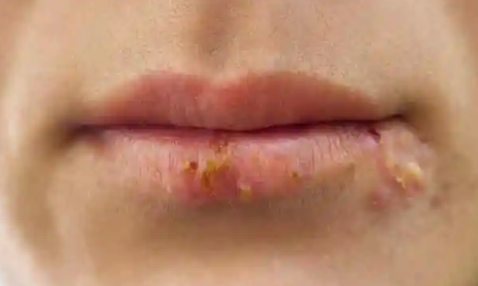 嘴唇|嘴唇疱疹结痂了还传染性吗