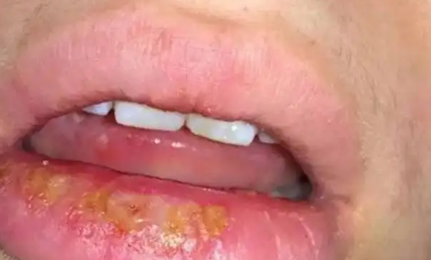 嘴唇|嘴唇疱疹结痂了还传染性吗