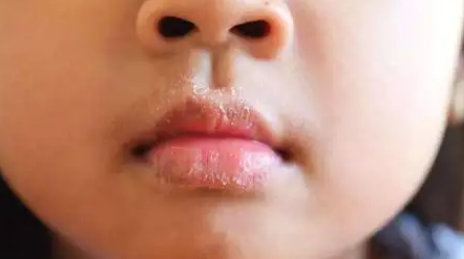 嘴唇|嘴唇疱疹会越来越多吗