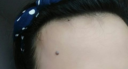 痣|嘴巴下的痣可以去掉吗