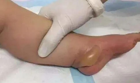 低温|低温烫伤可导致皮肤深层组织坏死吗